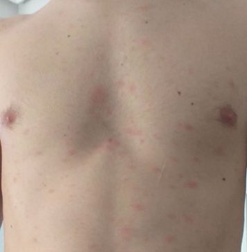 Hospital Costa del Sol: Estudio Multicéntrico COVID Piel